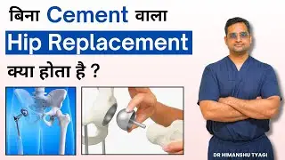 बिना Cement वाला Hip Replacement ? | cementless hip replacement (THR) AVN (avascular necrosis) 