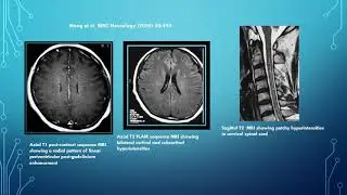 Neurology Quiz #25  Topics :GFAP astrocytopathy, vestibular migraine, anti GAD 65 diseases
