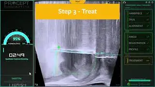 aquabeam