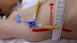 cvp measurements