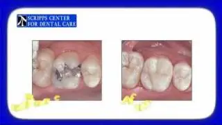 Restorative Dentistry in San Diego, California  Scripps Center for Dental Care
