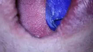 Leczenie laserem Cr Erb:YSSG ubytku zęba (Laser tooth treatment with Erb:YSGG laser.)