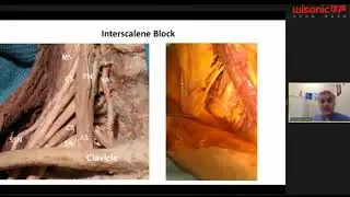 Upper Extremity Blocks: Current Insights