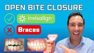 Correcting (Lateral) Open Bites With Invisalign (NEW METHOD)