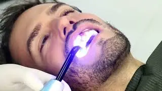 Carillas Dentales, Sonrisa perfecta.