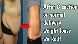After C section or normal delivery weight loose workout ।।