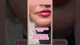 Stunning Bullhorn Lip Lift Transformation: 2 Weeks Post-Op