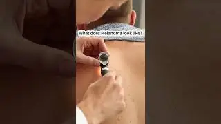 What Does Melanoma Look Like?
