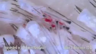 What do FUE NeoGrafts (Punchairmatic) look like in HD_.mp4