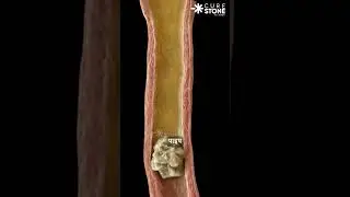 How kidney stones pass naturally | Kidney stones treatment