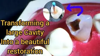 Removal a large Cavity and composite restoration