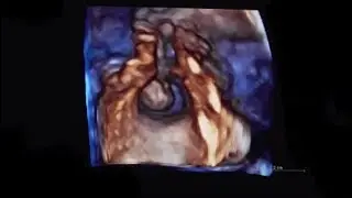 Left Atrial Appendage Thrombus (LAA thrombus)