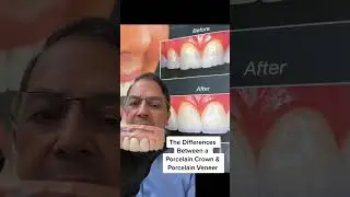 Porcelain Dental Crowns vs Porcelain Dental Veneers (WHAT'S THE DIFFERENCE?!) | View Mobile Dental