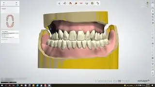 Bite Rim Scans For Complete Denture Digital Design