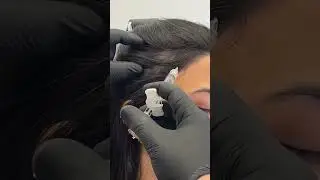Hair Loss Ends Here | Exosome Treatment with Dr. Rami Abadi #hairlosstreatment #exosomes
