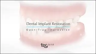 Fixture Level Open-Tray Impression