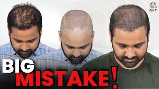 Hair Transplant in Pune (HX-HHDD) | Best Results & Cost of Hair Transplant in Pune.