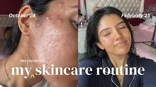 My *UNSPONSORED* Skincare Routine for Acne, Eczema & Sensitive Skin