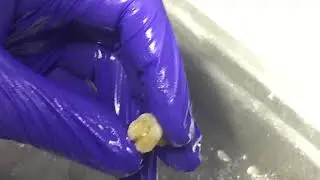 Endo Demo on Access Opening Upper Molar ||| KSU