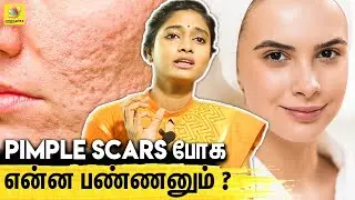 இந்த Type Pimples  இருக்கவங்க Careful ஆ இருக்கணும் - Skin Specialist Dr Archana Exclusive Interview