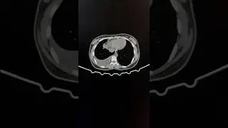 😱Pleural effusion||ct chest #radiology #viral #ct #radiologyeducation #shortsvideo #anatomy #hrct