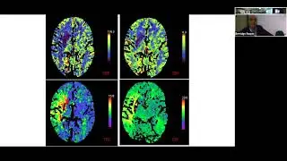 'Expanding the Role of Mechanical Thrombectomy for Stroke' by Dr Yogish Joshi