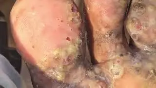 Susan Tieli's smothered jiggers & pus - see long vid @ riseupsociety.net & ruskenya.org