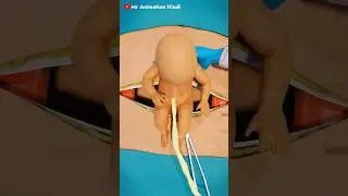 C-Section (Cesarean Delivery) Surgery - 3D Animation #medical #animation