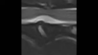 Thoracolumbar hydrated nucleus pulposus extrusion - clinical characteristics and MRI findings