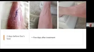 iTeraCare User Stories  - Amazing Leg Recovery #thzwater #thzblower #iteracare #testimonial