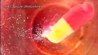 How Pills Dissolve In Your Stomach | Paano Natutunaw Ang Mga Pills Sa Iyong Tiyan