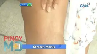 What are the effective ways to reduce stretch marks? | Pinoy MD