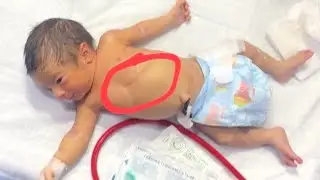 Newborn Life Saving Feeding Tube 🥹🍼 #newborncare #baby #neonatologist #feeding #NGtube 