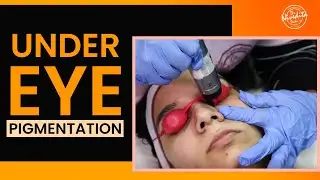 Laser treatment for dark circles under eyes | Under Eye Pigmentation Removal