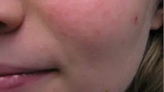 Rosacea - What causes it?