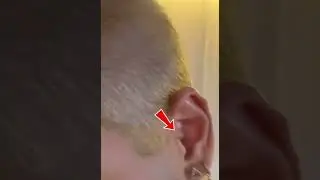 Z&eacute; fez um segundo furo na orelha