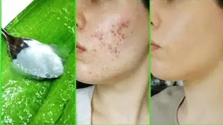 Remove Big Pimples, Small bumps, Large Open Pores |Aloevera Pack, Cystic Acne Removal, Dark Spots