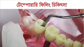 Temporary Filling Treatment Procedure ll Tech Dental