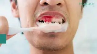 Best Toothpaste for Bleeding Gums, Swollen Gums, Inflammation and Pyria