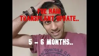 HAIR GROWTH CENTRE LONDON. MAIDA VALE. FUE TRANSPLANT CROWN TIMELINE. 5-6 MONTHS UPDATE.