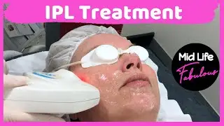 What is IPL? Watch my IPL treatment for my Rosacea #IPL