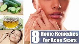 05 Most Effective Ways To Remove Acne Scars & Pimple Marks | Deep Scars & Pimple Marks  Removal |