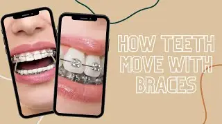 How Teeth Move With Braces #shorts