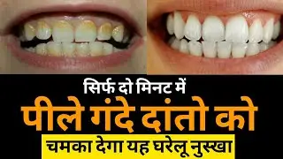 How to Whiten Your Yellow Teeth Naturally | Teeth Whitening at Home | Yellow Teeth Cleaning at Home