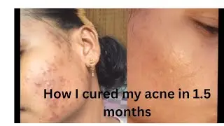 How I treated my acne in 1.5 month #acne #skincareroutine #acnestory #realskin #realresults #video