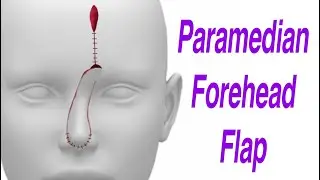 Paramedian Forehead Flap for Nasal Defect Reconstruction
