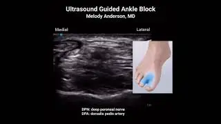 Ultrasound-Guided Ankle Block with Dr. Melody Anderson