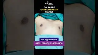 💪 Bodybuilder Gynecomastia Surgery | Just After Operation Result! 😲