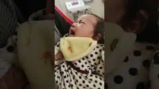 Inspiratory stridor in congenital laryngomalacia #laryngomalacia, #pediatrics, #clinicaltraining