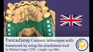 Exocad2019 - Tutorial preview - Connect telescopes with framework by using the attachment-tool
